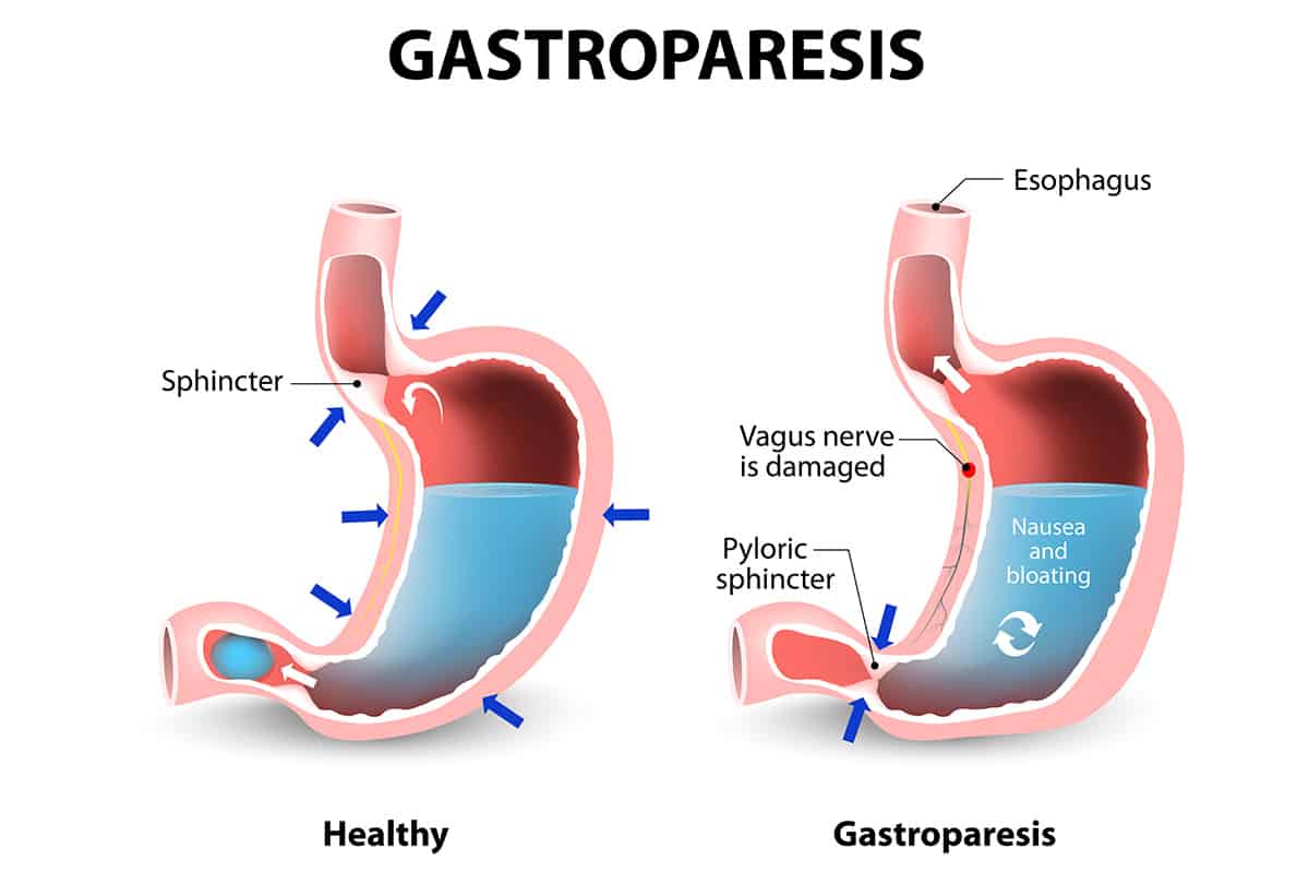 Best Meal Replacement Shakes for Gastroparesis